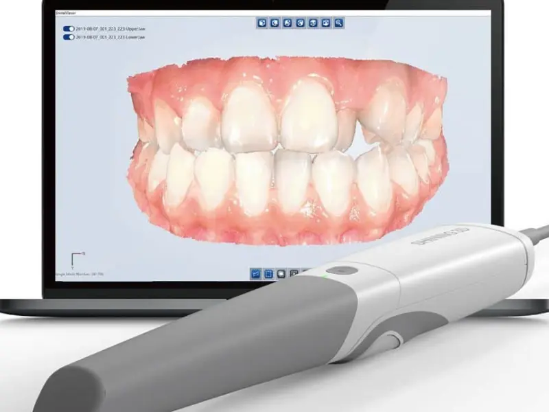 3D intraoral scanner beside a digital impression on screen